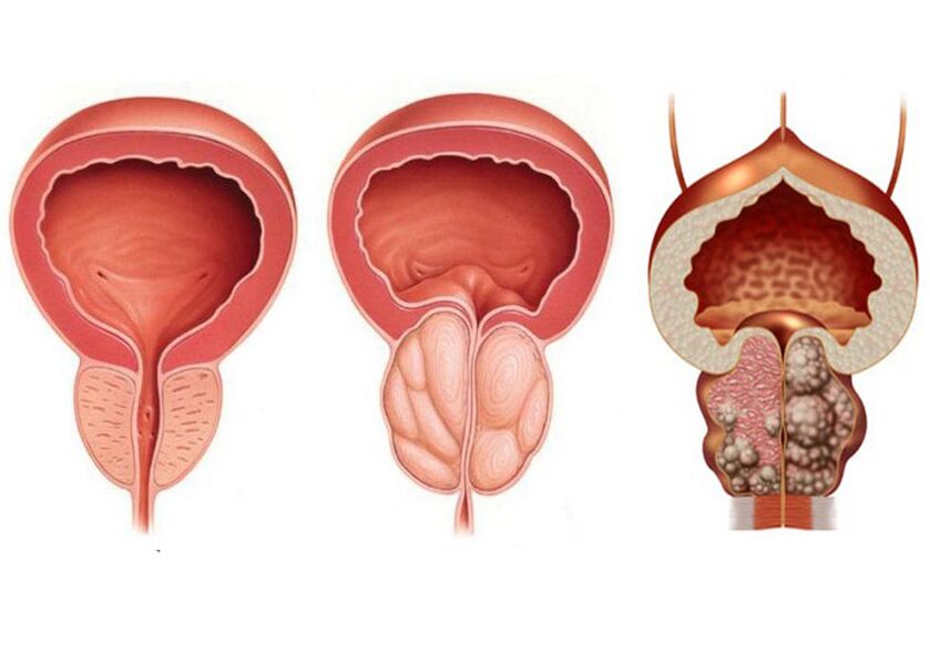 Prostatitin aşamaları ve prostavit tam olarak kullanma ihtiyacı